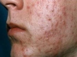 acne-in-adult